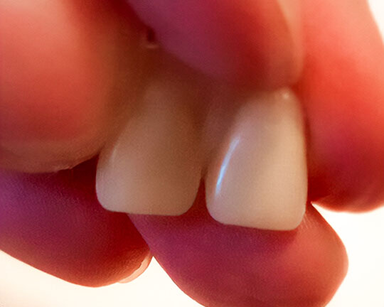 Dos coronas frontales de Denticor unidas, vista frontal
