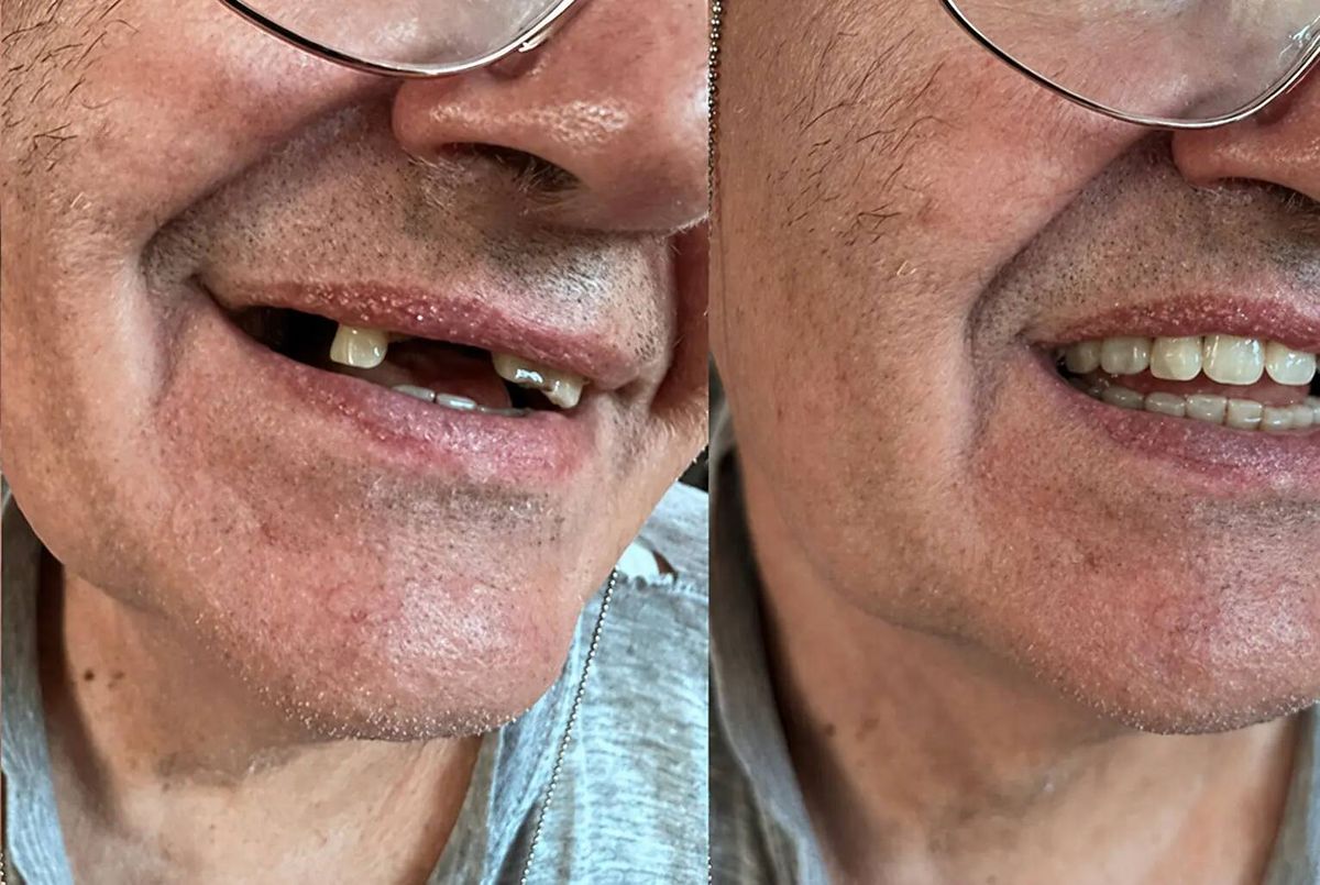 Del hueco a la sonrisa con la prótesis colocada