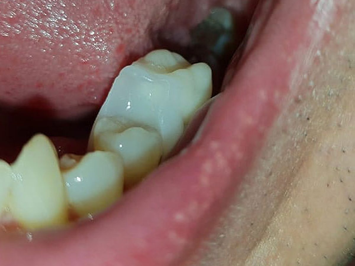Colocación de la prótesis Denticor adaptada en el lugar del diente posterior que falta