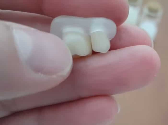 Dos coronas unidas por un puente de DentiFlex, vista desde la parte posterior