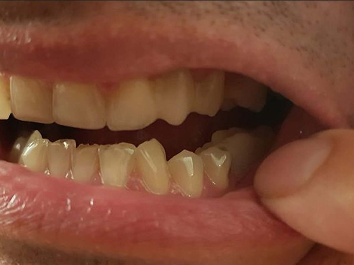 Prótesis Denticor colocada en el lugar del diente posterior que le falta