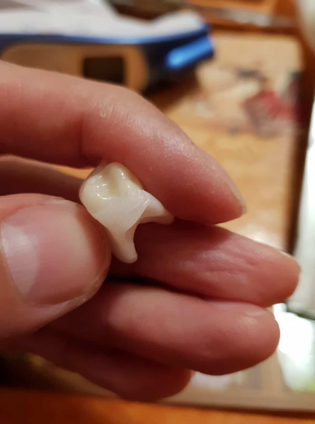 Prótesis dental Denticor definitiva tras meses de desarrollo