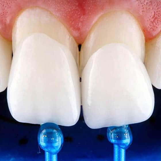 Carillas Denticor: recubrimiento estético de los dientes frontales