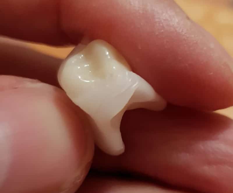 1 · Corona unida al DentiFlex