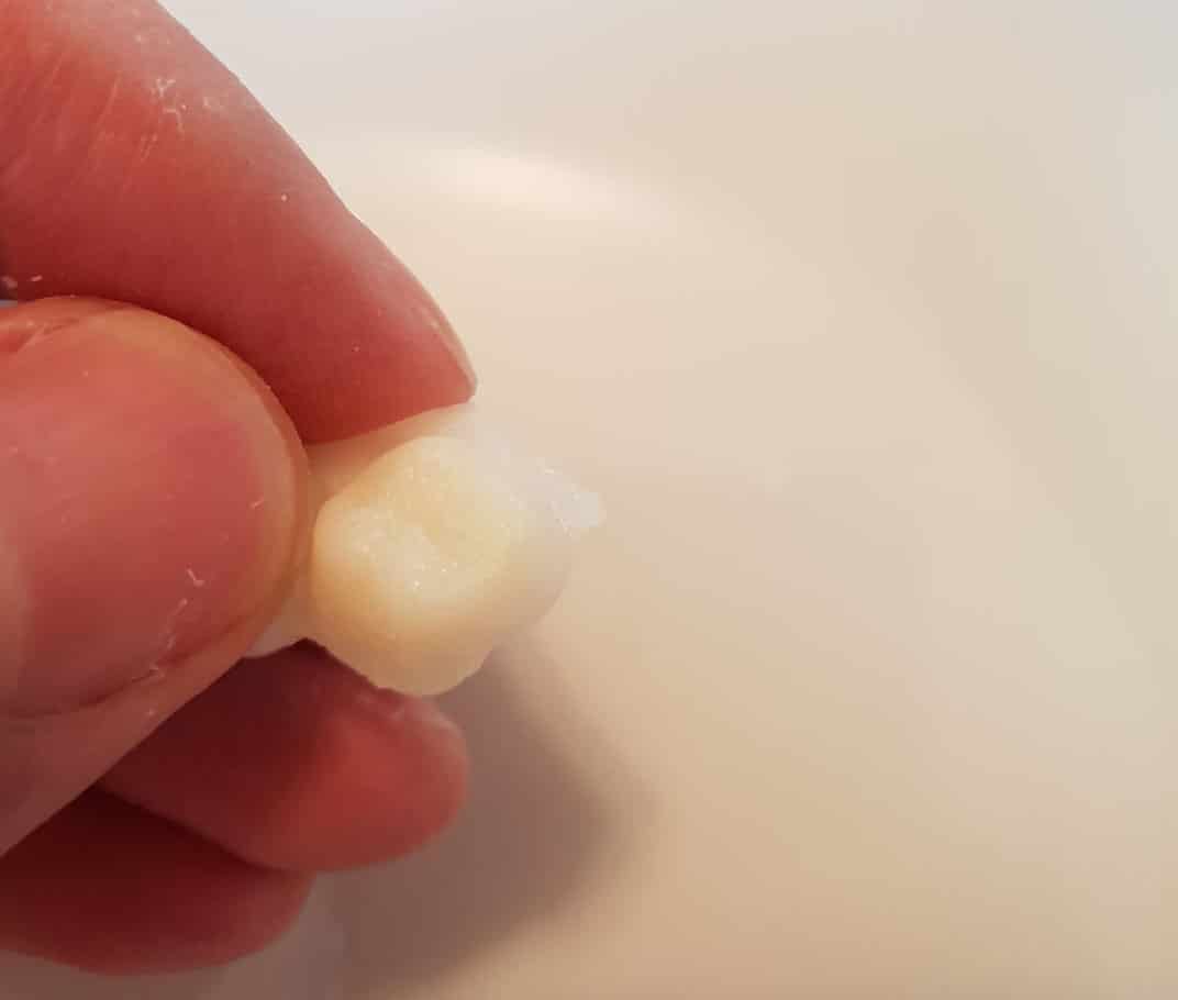 Primer prototipo de prótesis dental Denticor