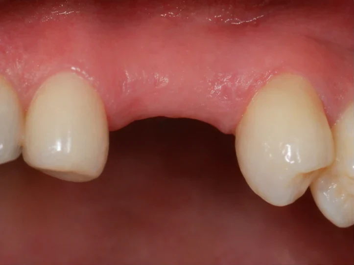 Procedimiento con Denticor para un canino: espacio cicatrizado, corona en DentiFlex, inserción entre los dientes y un puente final fino