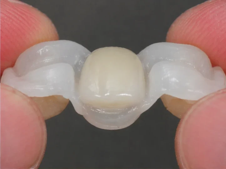 Procedimiento con Denticor para un canino: espacio cicatrizado, corona en DentiFlex, inserción entre los dientes y un puente final fino