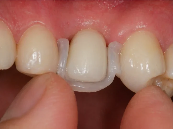 Procedimiento con Denticor para un canino: espacio cicatrizado, corona en DentiFlex, inserción entre los dientes y un puente final fino