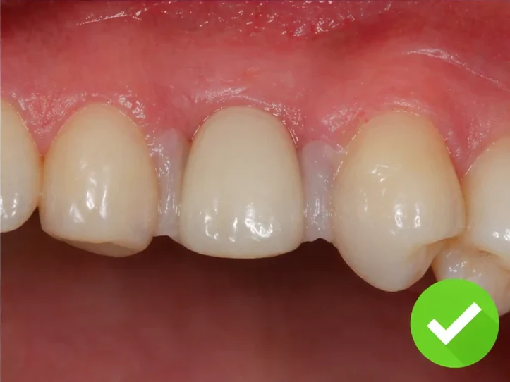 Procedimiento con Denticor para un canino: espacio cicatrizado, corona en DentiFlex, inserción entre los dientes y un puente final fino