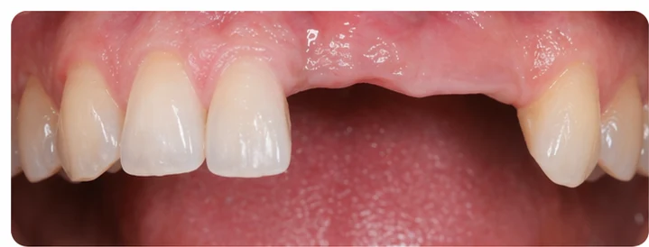 Procedimiento visual para dos premolares y un molar inferiores: principio de colocación del puente Denticor con los nuevos dientes y su ajuste a los dientes adyacentes