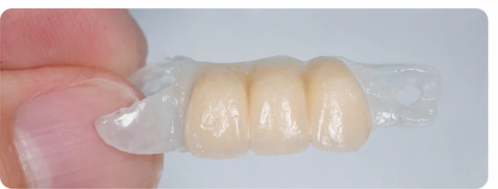 Procedimiento visual para dos premolares y un molar inferiores: principio de colocación del puente Denticor con los nuevos dientes y su ajuste a los dientes adyacentes