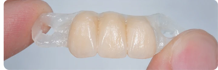 Procedimiento visual para dos premolares y un molar inferiores: principio de colocación del puente Denticor con los nuevos dientes y su ajuste a los dientes adyacentes