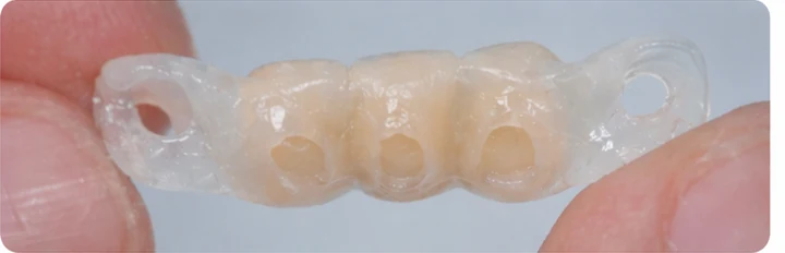 Procedimiento visual para dos premolares y un molar inferiores: principio de colocación del puente Denticor con los nuevos dientes y su ajuste a los dientes adyacentes