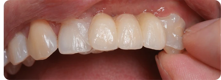 Procedimiento visual para dos premolares y un molar inferiores: principio de colocación del puente Denticor con los nuevos dientes y su ajuste a los dientes adyacentes