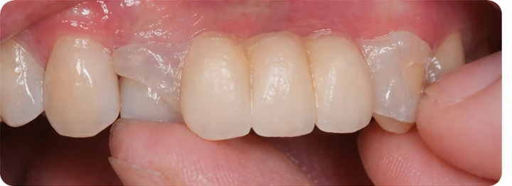 Procedimiento visual para dos premolares y un molar inferiores: principio de colocación del puente Denticor con los nuevos dientes y su ajuste a los dientes adyacentes