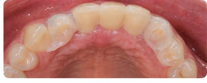 Procedimiento visual para dos premolares y un molar inferiores: principio de colocación del puente Denticor con los nuevos dientes y su ajuste a los dientes adyacentes