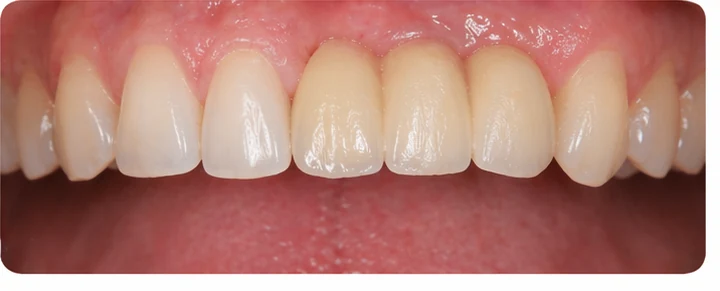 Procedimiento visual para dos premolares y un molar inferiores: principio de colocación del puente Denticor con los nuevos dientes y su ajuste a los dientes adyacentes