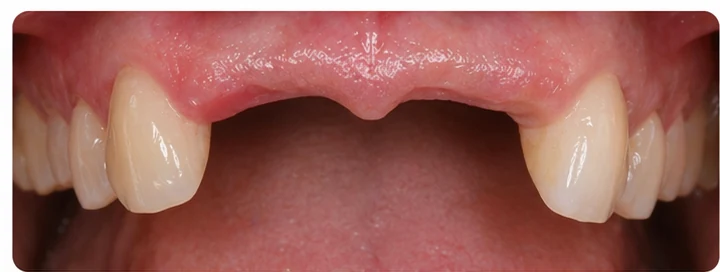 Procedimiento visual para dos dientes frontales inferiores adyacentes: principio de colocación del puente Denticor con los nuevos dientes y su ajuste a los dientes circundantes