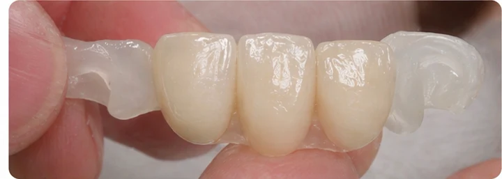 Procedimiento visual para dos dientes frontales inferiores adyacentes: principio de colocación del puente Denticor con los nuevos dientes y su ajuste a los dientes circundantes