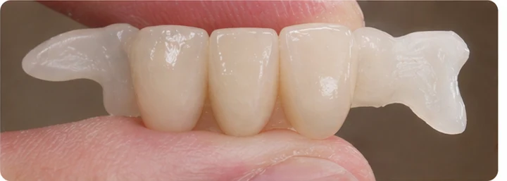 Procedimiento visual para dos dientes frontales inferiores adyacentes: principio de colocación del puente Denticor con los nuevos dientes y su ajuste a los dientes circundantes