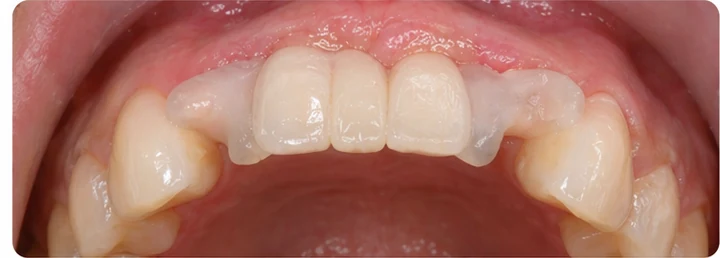 Procedimiento visual para dos dientes frontales inferiores adyacentes: principio de colocación del puente Denticor con los nuevos dientes y su ajuste a los dientes circundantes