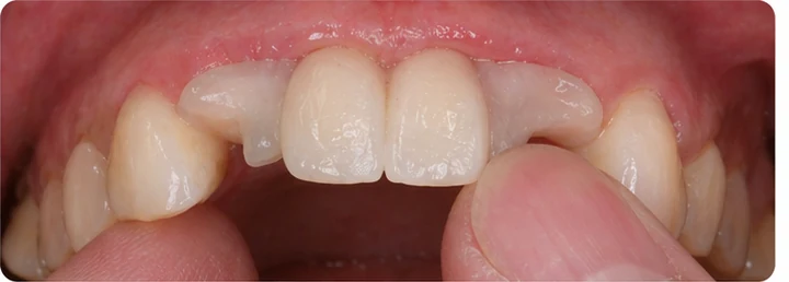Procedimiento visual para dos dientes frontales inferiores adyacentes: principio de colocación del puente Denticor con los nuevos dientes y su ajuste a los dientes circundantes