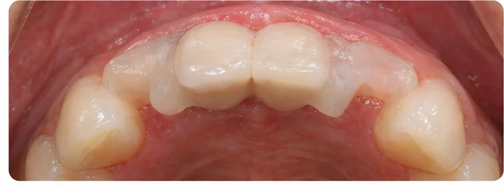 Procedimiento visual para dos dientes frontales inferiores adyacentes: principio de colocación del puente Denticor con los nuevos dientes y su ajuste a los dientes circundantes