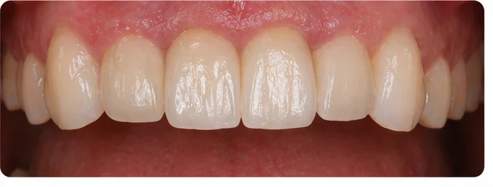 Procedimiento visual para dos dientes frontales inferiores adyacentes: principio de colocación del puente Denticor con los nuevos dientes y su ajuste a los dientes circundantes