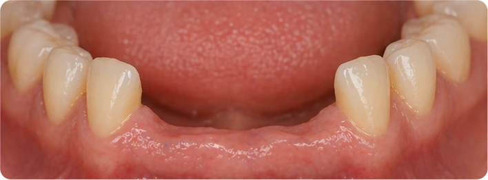 Guía visual: diente superior y premolar ausentes