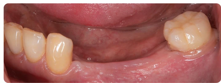 Procedimiento visual para los tres dientes posteriores inferiores: principio de colocación del puente Denticor con los nuevos dientes y su ajuste a los dientes adyacentes