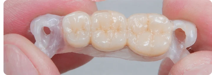 Procedimiento visual para los tres dientes posteriores inferiores: principio de colocación del puente Denticor con los nuevos dientes y su ajuste a los dientes adyacentes