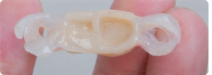 Procedimiento visual para los tres dientes posteriores inferiores: principio de colocación del puente Denticor con los nuevos dientes y su ajuste a los dientes adyacentes