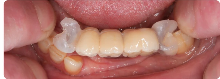 Procedimiento visual para los tres dientes posteriores inferiores: principio de colocación del puente Denticor con los nuevos dientes y su ajuste a los dientes adyacentes