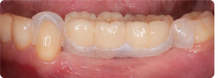 Procedimiento visual para los tres dientes posteriores inferiores: principio de colocación del puente Denticor con los nuevos dientes y su ajuste a los dientes adyacentes