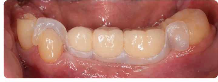 Procedimiento visual para los tres dientes posteriores inferiores: principio de colocación del puente Denticor con los nuevos dientes y su ajuste a los dientes adyacentes