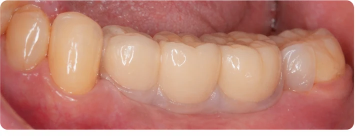 Procedimiento visual para los tres dientes posteriores inferiores: principio de colocación del puente Denticor con los nuevos dientes y su ajuste a los dientes adyacentes