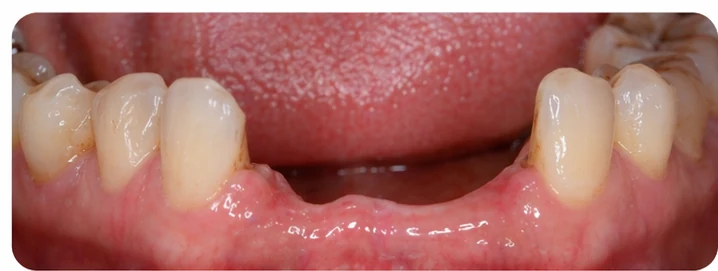 Demostración de la colocación de Denticor para un canino inferior y dos premolares: colocación del sustituto y modelado de su soporte contra los dientes vecinos