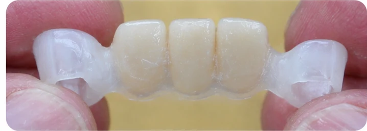 Demostración de la colocación de Denticor para un canino inferior y dos premolares: colocación del sustituto y modelado de su soporte contra los dientes vecinos