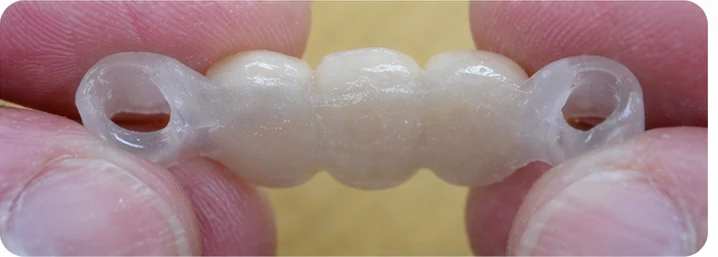 Demostración de la colocación de Denticor para un canino inferior y dos premolares: colocación del sustituto y modelado de su soporte contra los dientes vecinos
