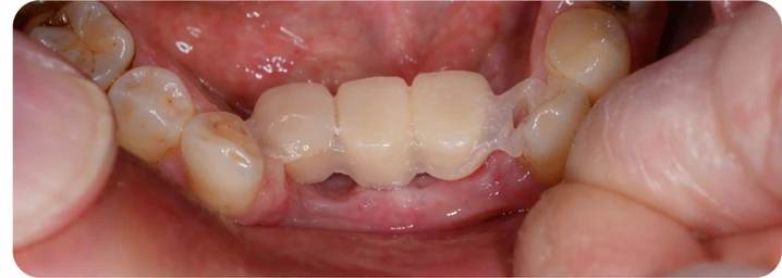 Demostración de la colocación de Denticor para un canino inferior y dos premolares: colocación del sustituto y modelado de su soporte contra los dientes vecinos