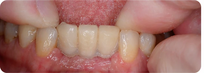 Demostración de la colocación de Denticor para un canino inferior y dos premolares: colocación del sustituto y modelado de su soporte contra los dientes vecinos