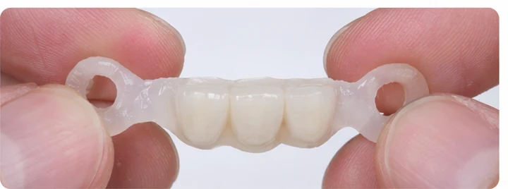Procedimiento visual para tres dientes contiguos en la arcada inferior: principio de colocación del puente Denticor con los nuevos dientes y su modelado alrededor de los dientes adyacentes