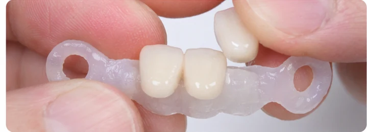 Guía visual: falta de tres dientes frontales superiores