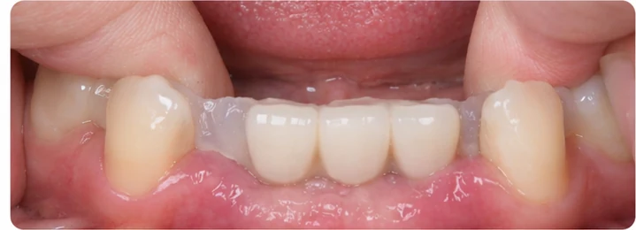 Guía visual: falta de tres dientes frontales superiores