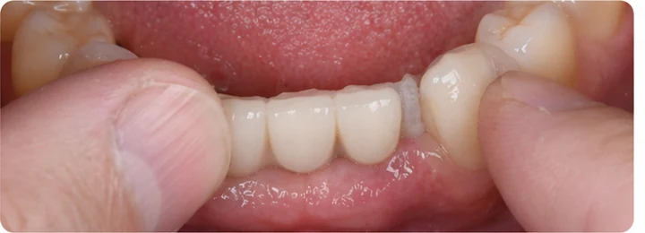 Guía visual: falta de tres dientes frontales superiores