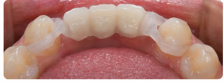Guía visual: falta de tres dientes frontales superiores
