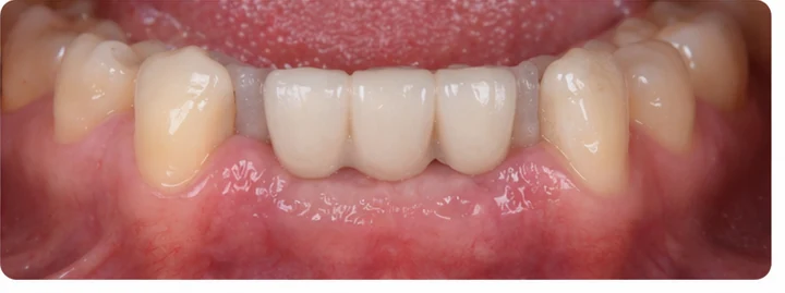 Procedimiento visual para tres dientes contiguos en la arcada inferior: principio de colocación del puente Denticor con los nuevos dientes y su modelado alrededor de los dientes adyacentes