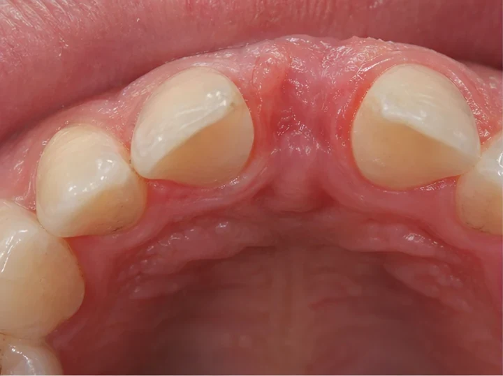 Vista posterior de los dientes frontales: DentiFlex forma un cierre detrás de los dientes adyacentes