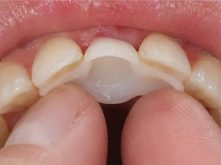 Vista posterior de los dientes frontales: DentiFlex forma un cierre detrás de los dientes adyacentes