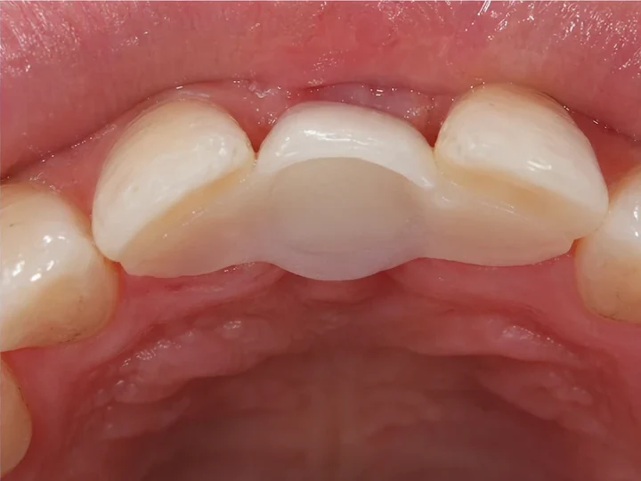 2 · La pieza completa apoyada en los dientes adyacentes